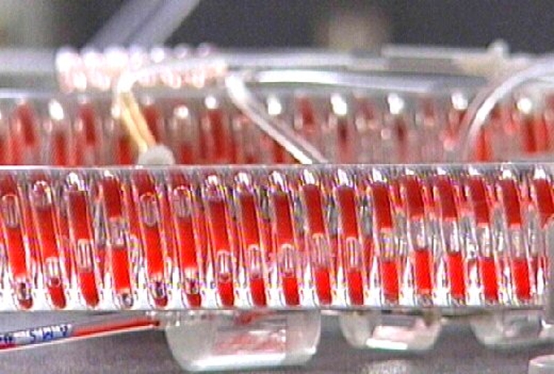 Blood samples - Probable case of vCJD