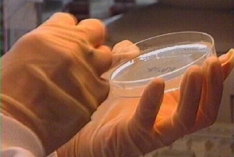 MRSA - Superbug prevalent, report says