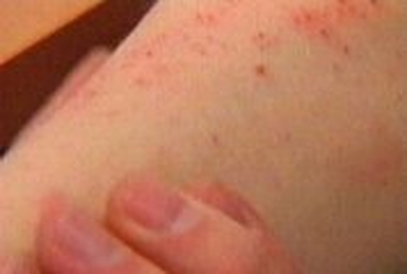 Eczema - Breakthrough in research