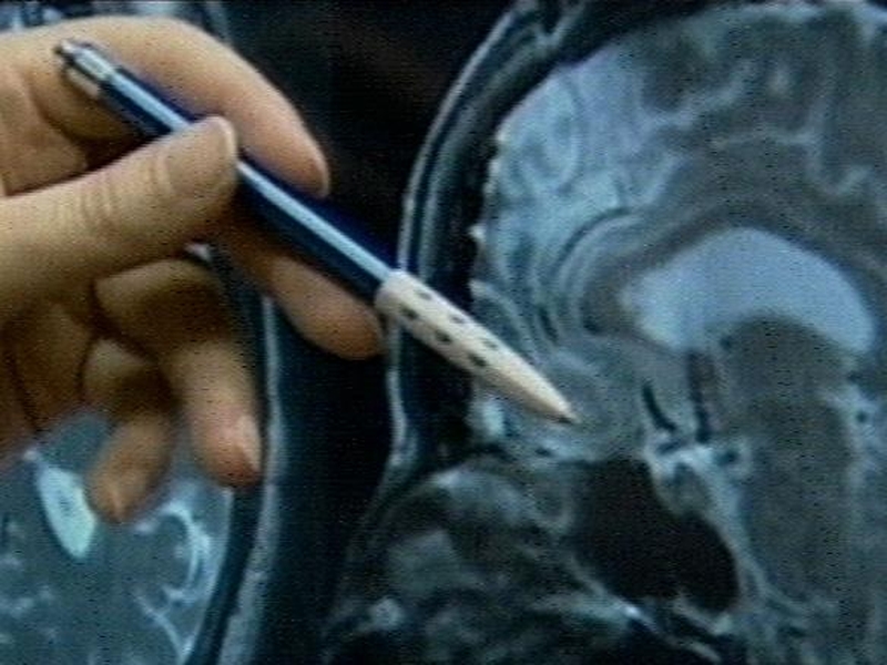 Research - Test for Alzheimer's promised