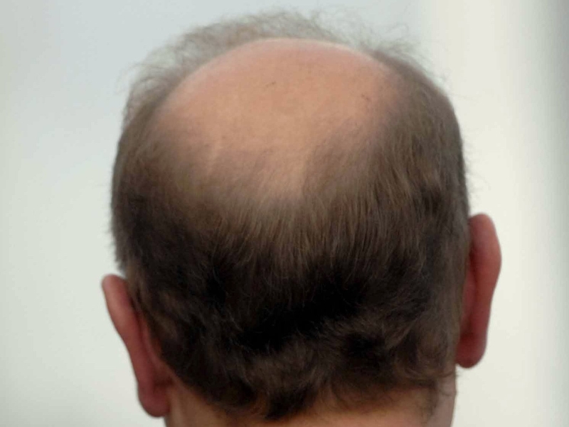 Baldness - Scientists isolate key genes
