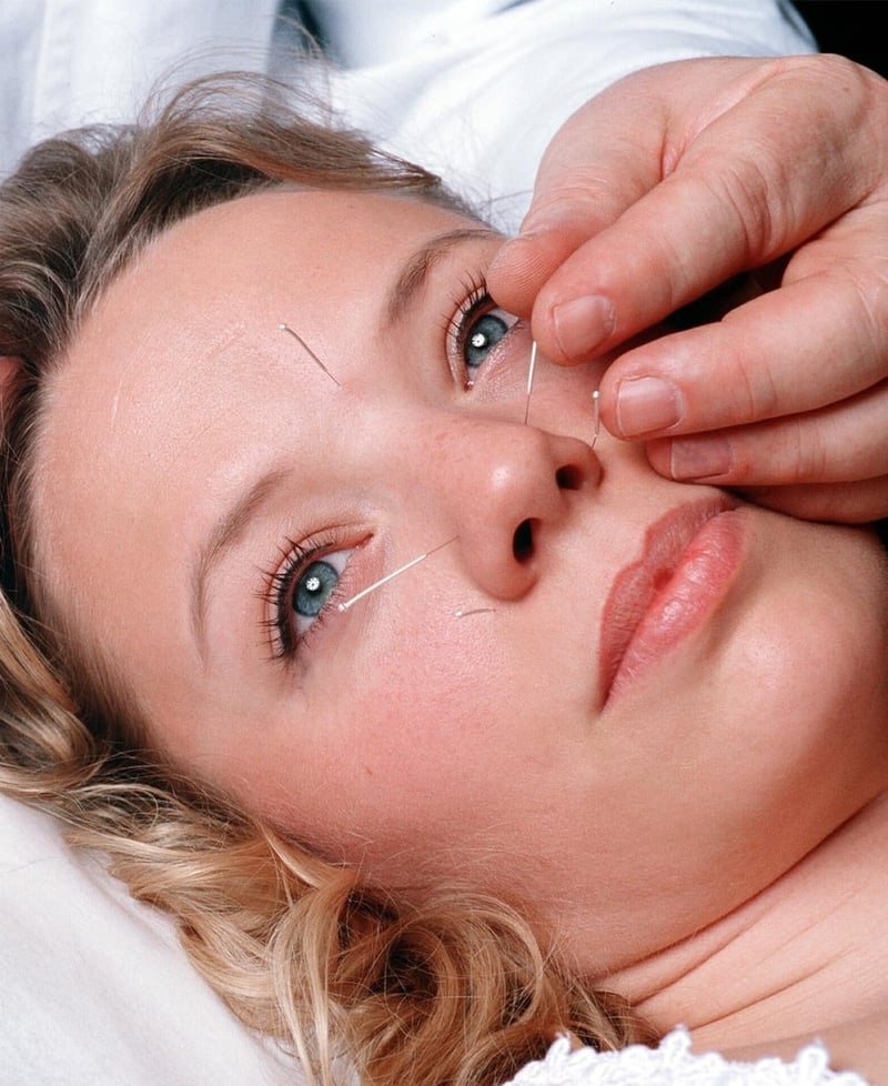 Cosmetic Acupuncture - The new beauty treatment