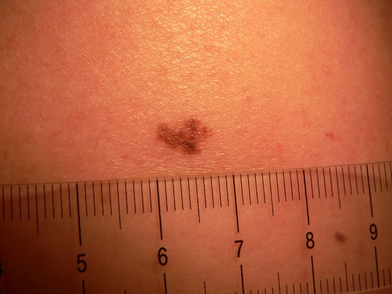 Melanoma - Concern over increase in cases