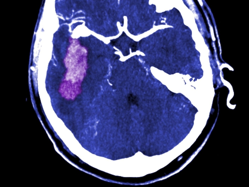 Stroke - Report on cardiovascular services