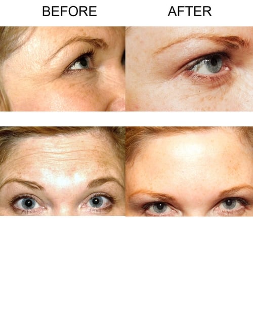 Georgina Heffernan pictured before and after the Botox procedure