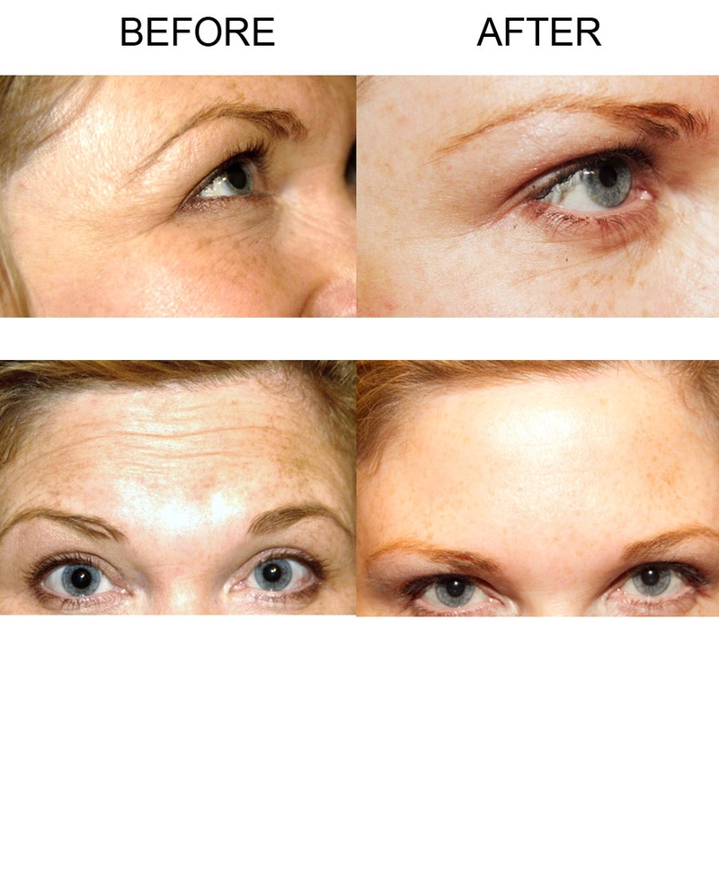 Georgina Heffernan pictured before and after the Botox procedure