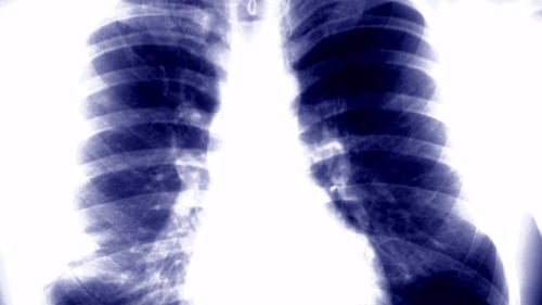 TB claims 1.3 million lives each year across the globe