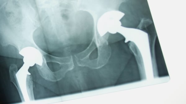 Hip replacement - Problem with DePuy device