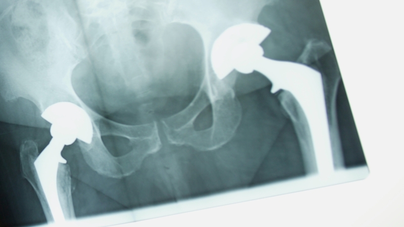 Hip Replacement - Worldwide recall of device