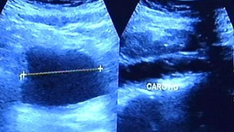 Warnings that high carbohydrate diet may be a potential factor in breast cancer