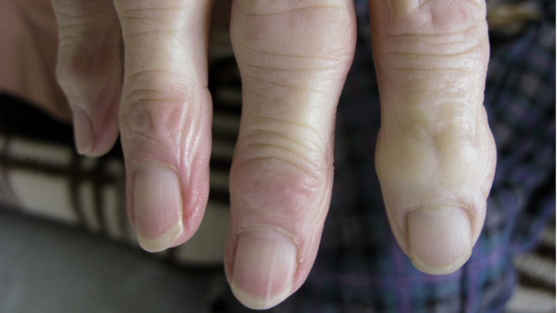 Pain - Chronic pain can be caused by a large range of conditions