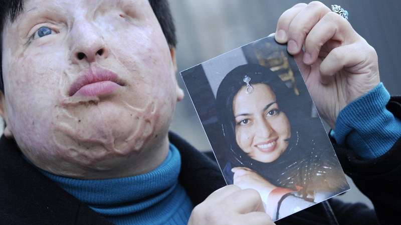 Ameneh Bahrami - Had acid thrown over her in 2004