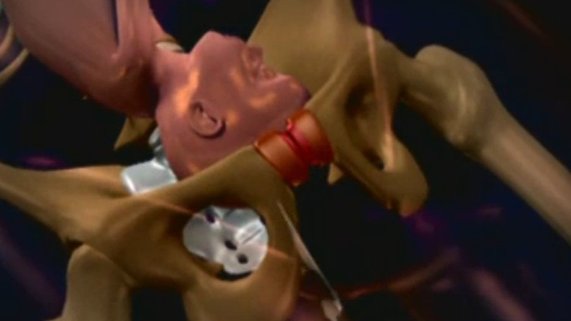 Symphysiotomy - Unreserved sympathy expressed