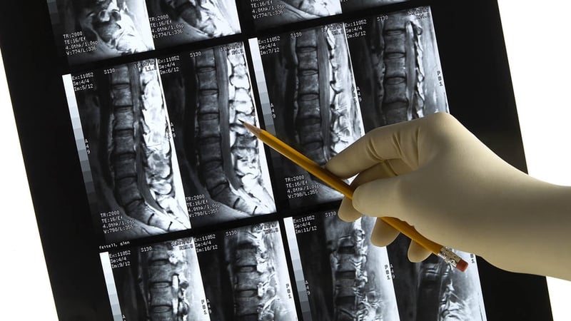 "Current figures indicate that over 900,000 people in Ireland live with some type of arthritis making it the biggest cause of disability"