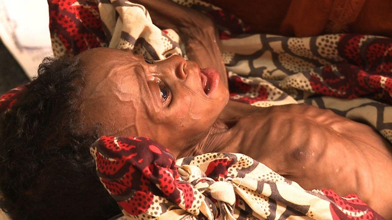 Six-month-old Agaicha had been struggling to stay alive, but is now responding well to treatment at a Concern supported hospital in Tahoua