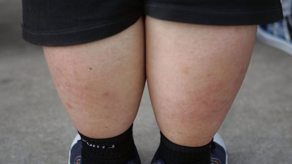 Overweight children often have weight problems in adulthood too