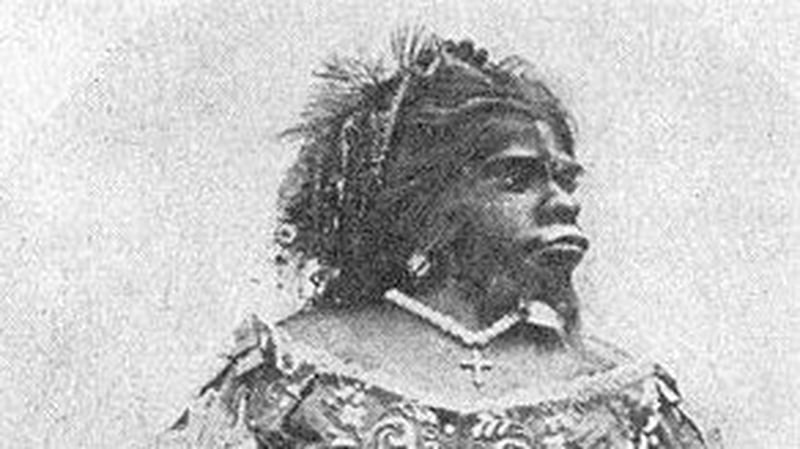 Julia Pastrana suffered from hypertrichosis and gingival hyperplasia