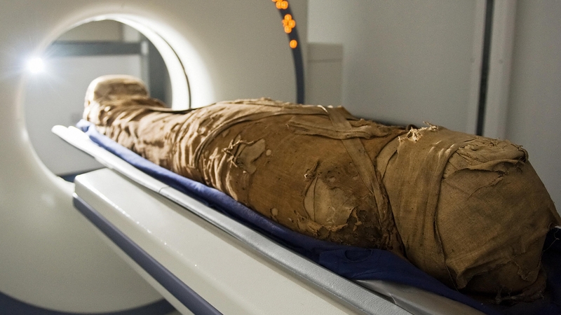 CT scans of 137 mummies showed evidence of atherosclerosis, or hardened arteries, in one third of those examined