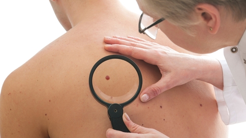 Ipilimumab is used to treat malignant melanomas