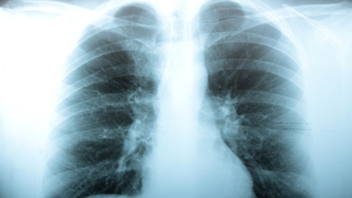 People with a certain combination of genes have an increased risk of developing COPD
