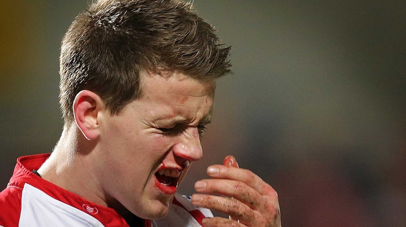 Craig Gilroy suffered a broken nose against Montpellier
