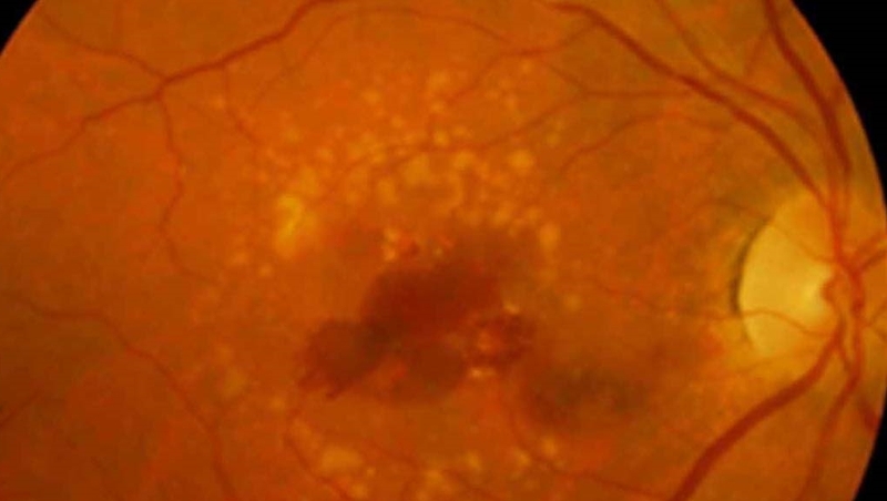 100,000 people undergo corneal transplants each year