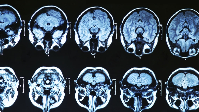 During adolescence, the brain undergoes widespread re-wiring that involves 'synaptic pruning'