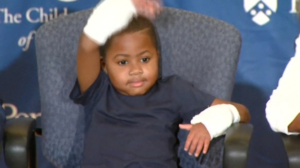 Zion Harvey had his hands amputated when he was two after a serious infection