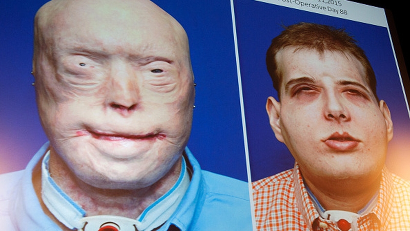 Patrick Hardison suffered extensive facial burns as a volunteer firefighter