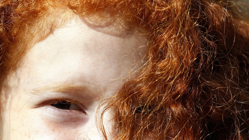 Red-haired people all have two copies of the MC1R gene variant