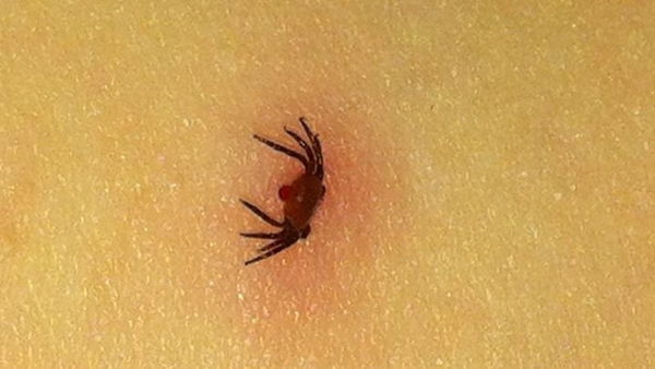 Lyme disease is spread by infected biting ticks