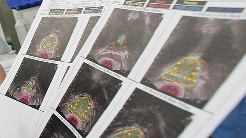 People do not always avail of cancer screening programmes