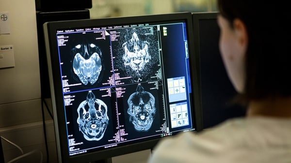 Researchers stressed that the chances of developing Alzheimer's after a brain injury remained low (File pic)