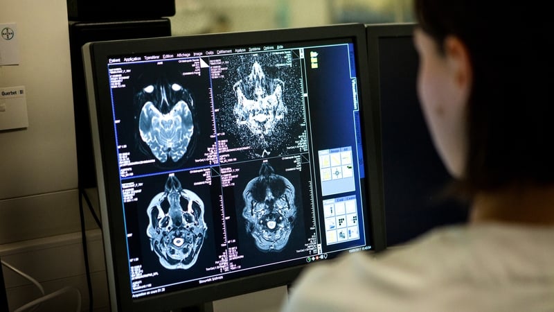 Researchers stressed that the chances of developing Alzheimer's after a brain injury remained low (File pic)