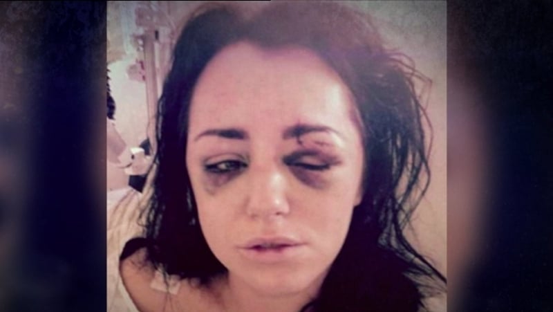 Jessica Bowes was left with fractured eye sockets, skull and face, and a shattered cheek bone after an assault by an ex in 2015