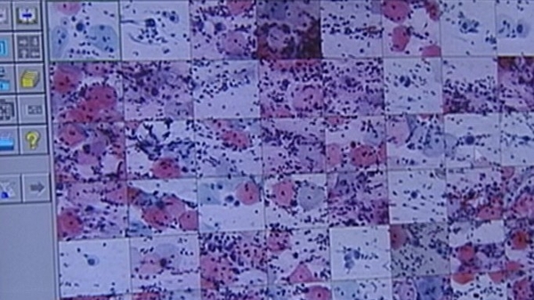 CervicalCheck controversy - A timeline of key events