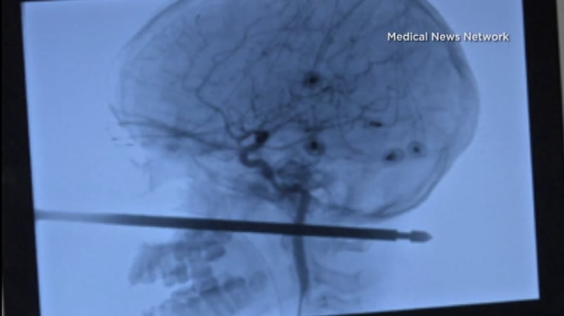 The 30cm skewer was embedded from Xavier Cunningham's cheekbone to the back of his neck