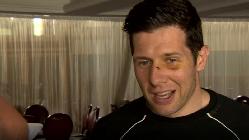 Cavanagh showing his cut nose and black eye