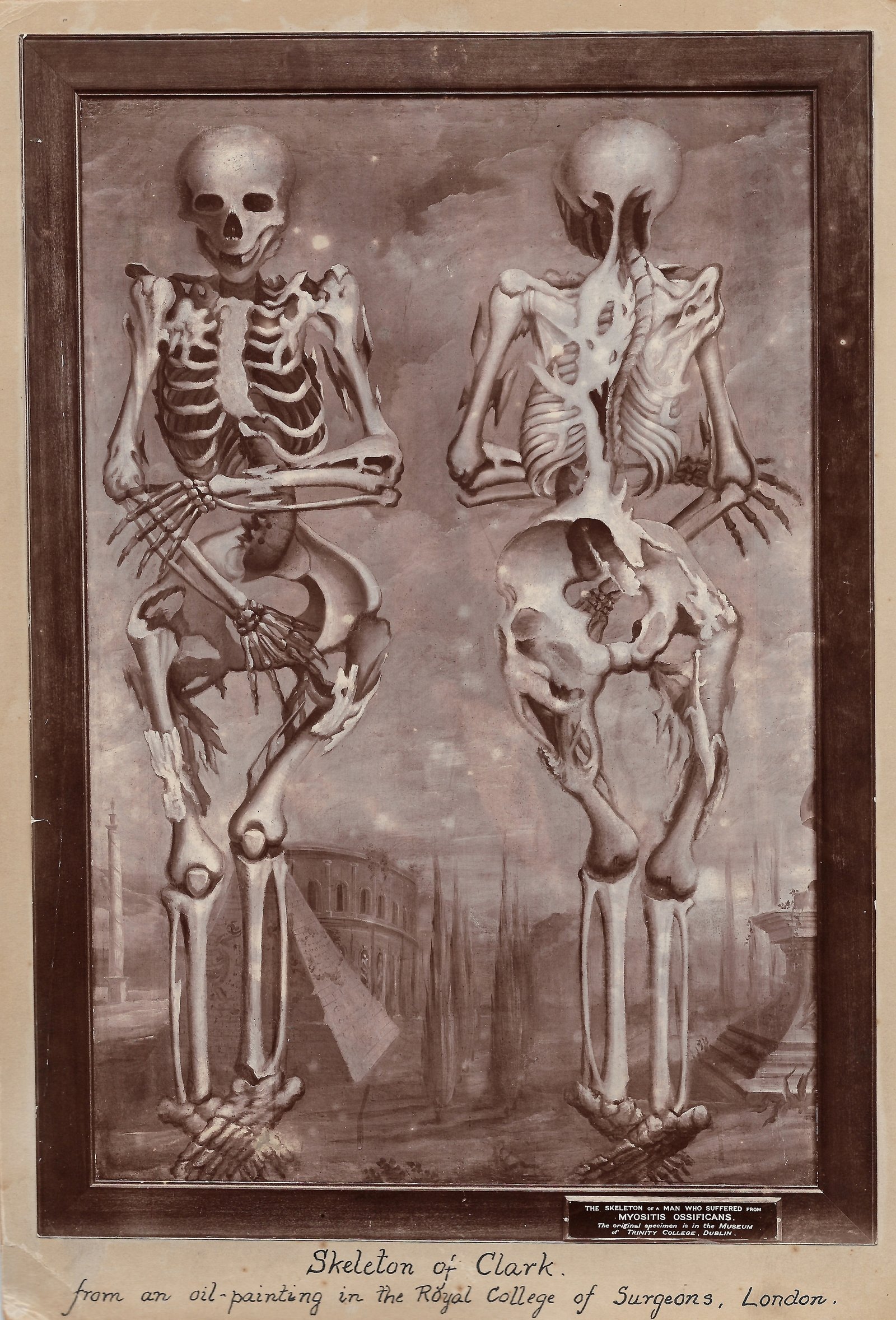 Image of William Clark's skeleton copied from oil painting in the Royal College of Surgeons, London.