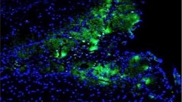 "Contrary to common conceptions, schizophrenia does not involve split personalities, but rather has been described by sufferers as "having a shattered mind"."