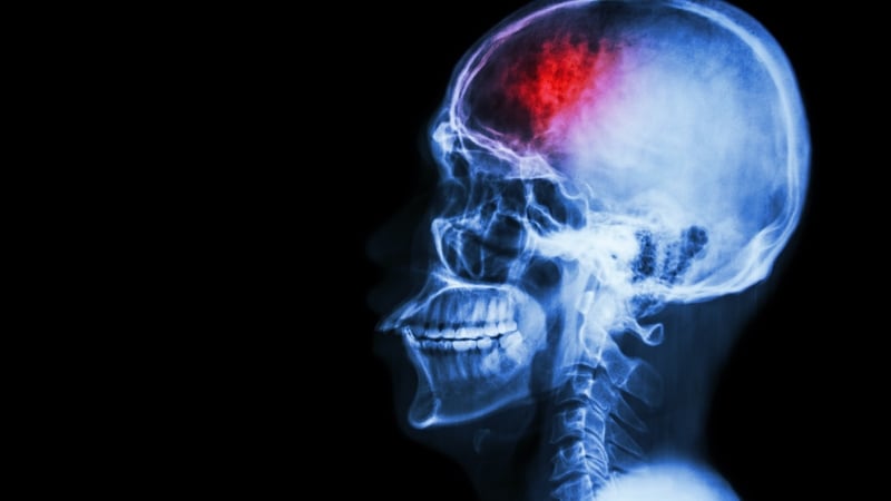 "Stroke can have a wide range of affects on our lives with such common movement problems as paralysis of one side, arm weakness and impaired walking"