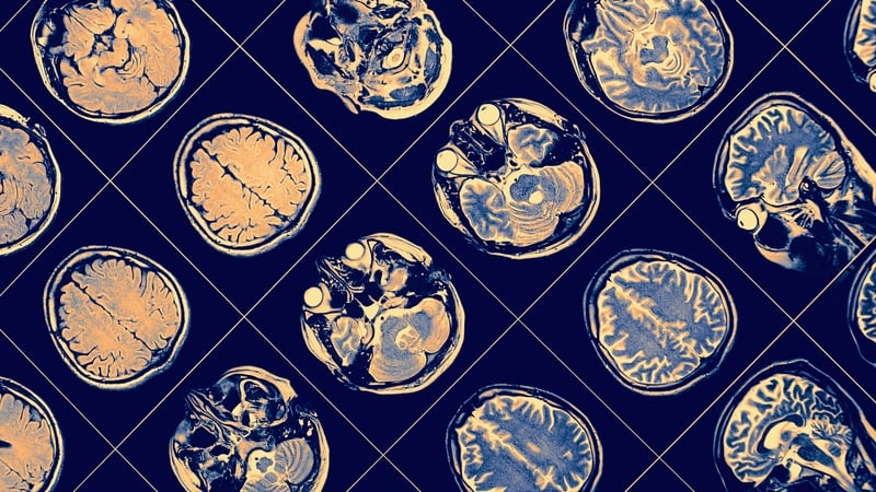 "There is no completely accurate test for Parkinson's disease, so the rate of misdiagnosis may be relatively high"