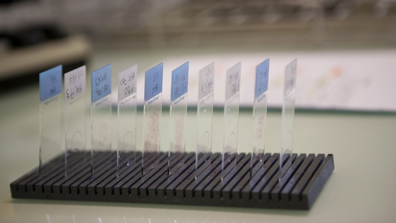 The HSE and two labs were successfully sued over the misreading of cervical smear tests