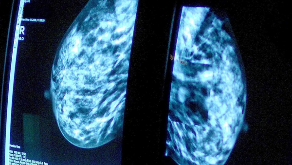 The study of ribociclib was described as a 'very important and practice-changing clinical trial'