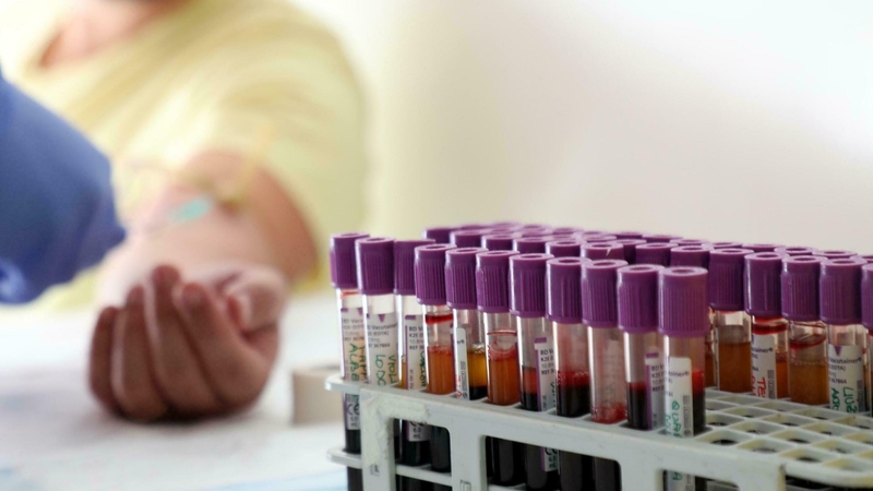 Patients with epilepsy at Beaumont Hospital and at a hospital in Germany were part of the study