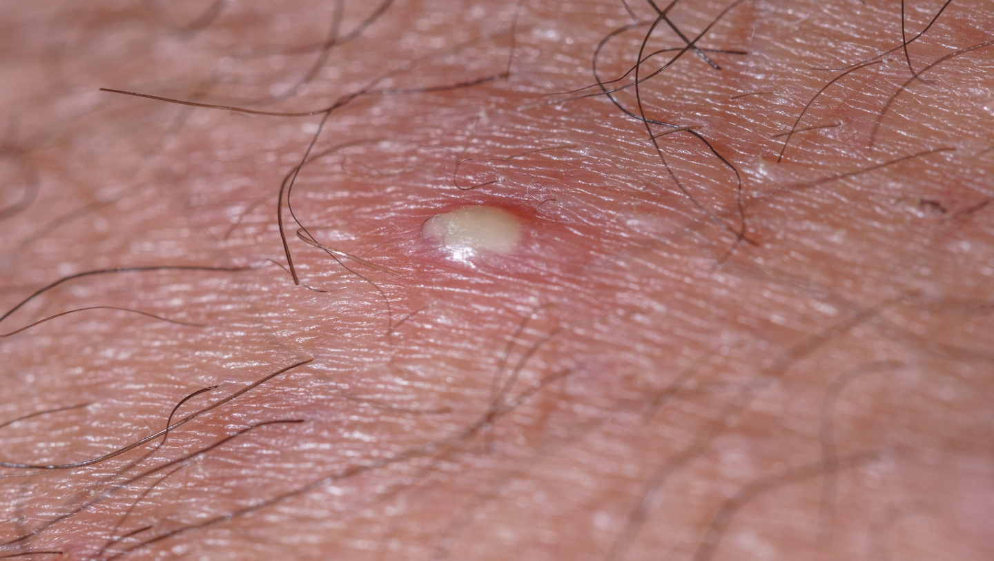 Close-up of skin with a single pus-filled pustule and surrounding short hairs, showing inflammation