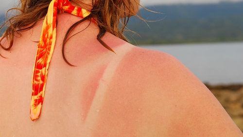 How to avoid and treat sunburn this summer.