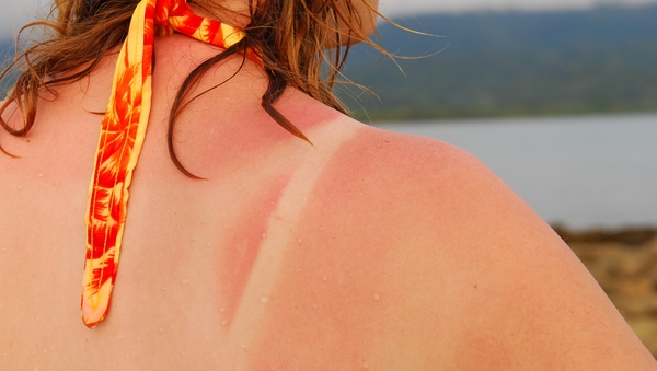 How to avoid and treat sunburn this summer.