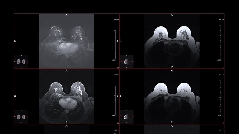 "To date, only a very small number of online programmes exist that relate to supporting breast cancer patients"