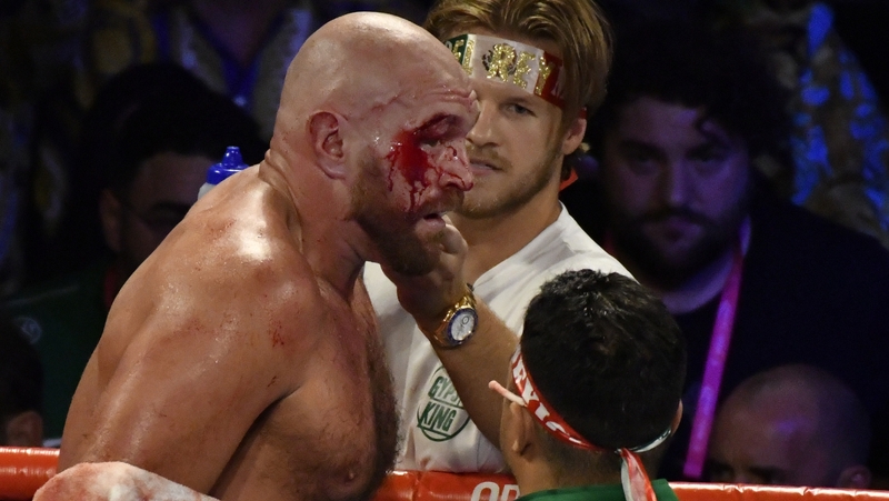 Tyson Fury had to see a plastic surgeon after the Vegas fight